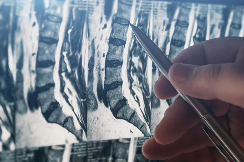 A close up image of an x-ray of a spinal disc that is damaged or deteriorating.