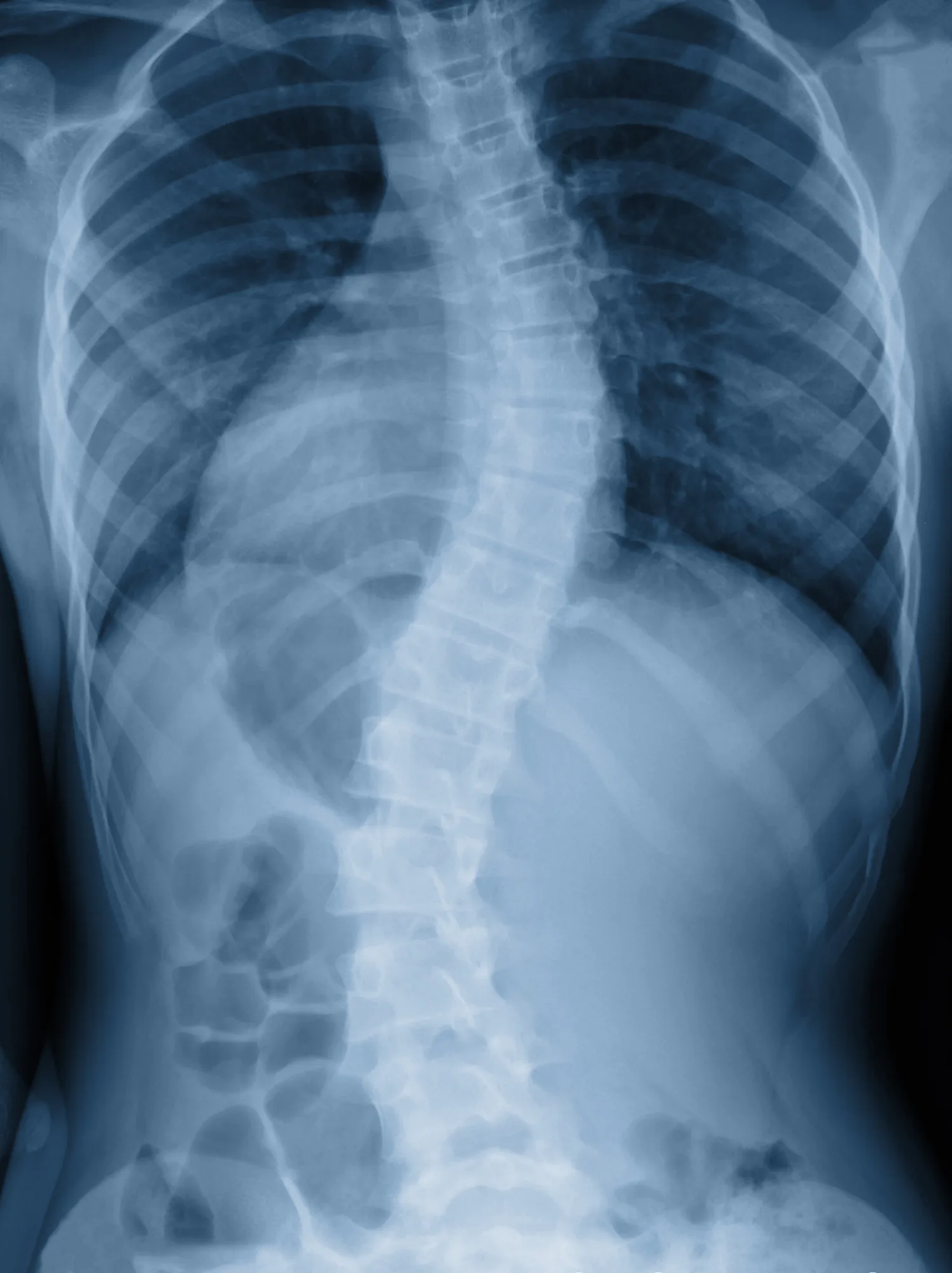 An x-ray image of an individual who is experiencing Scoliosis